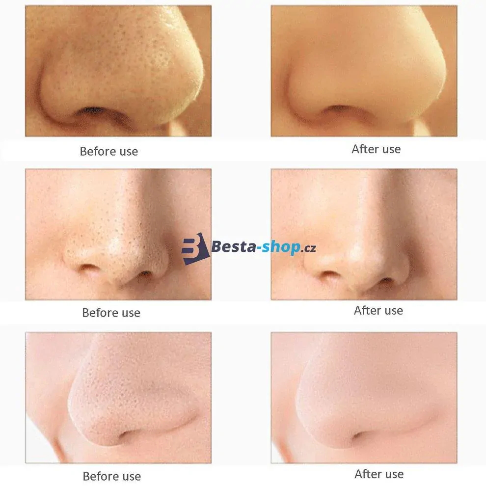 DermaSuction vakuový čistič pokožky